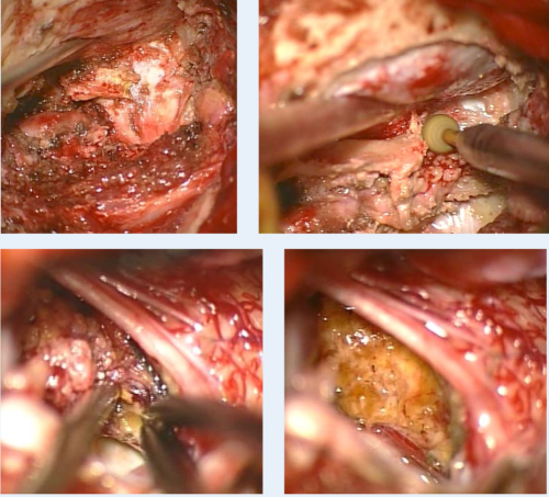 腦干延髓海綿狀血管瘤案例