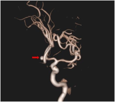 腦動(dòng)脈瘤破裂風(fēng)險(xiǎn)有多大？