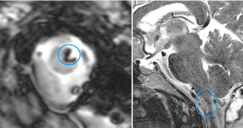 術(shù)后MR——腦干延髓海綿狀血管瘤