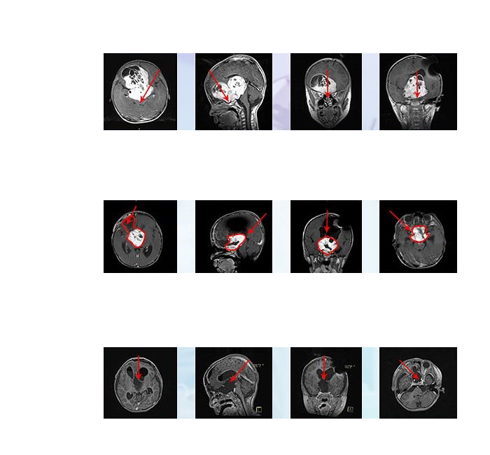 視神經(jīng)膠質(zhì)瘤
