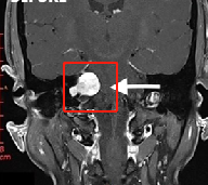 聽(tīng)神經(jīng)瘤手術(shù)后面癱多久能恢復(fù)？術(shù)前需要做什么準(zhǔn)備？