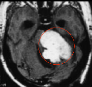 聽(tīng)神經(jīng)瘤是大手術(shù)嗎？術(shù)后聽(tīng)不見(jiàn)、面癱的概率高不高？