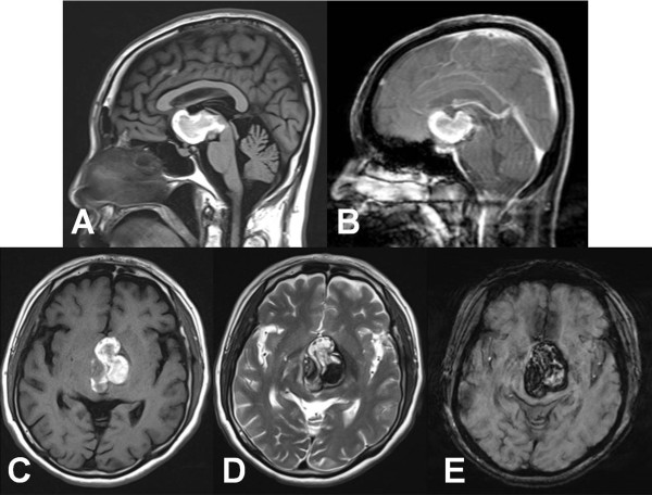 腦海綿狀血管瘤案例