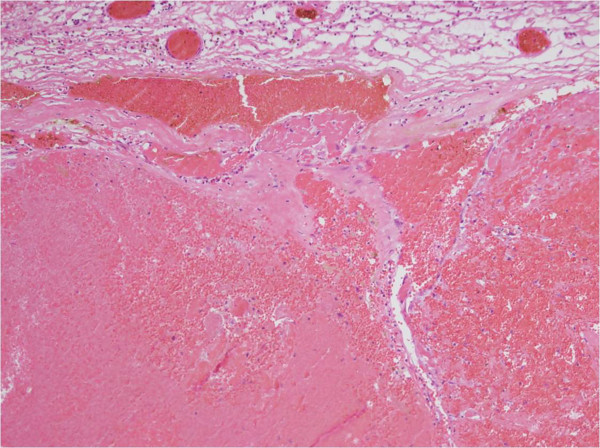 <a href='/qianyan/xueguanliu/' target='_blank'><u>腦干海綿狀血管瘤</u></a>