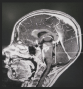 成人腦干膠質(zhì)瘤能活多久？5年生存率分析