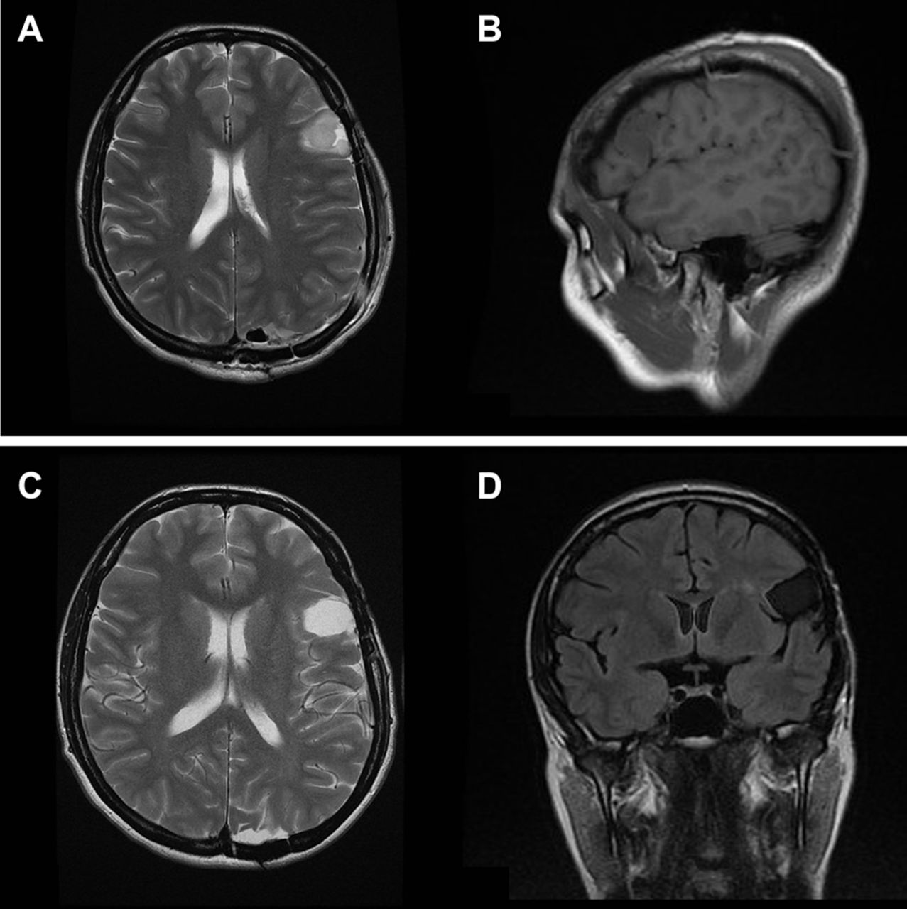 4級腦膠質(zhì)瘤能活幾年？