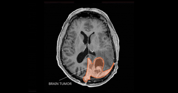 腦膜瘤復(fù)發(fā)率高嗎？