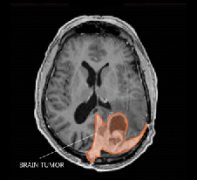 腦膜瘤復(fù)發(fā)率高嗎？