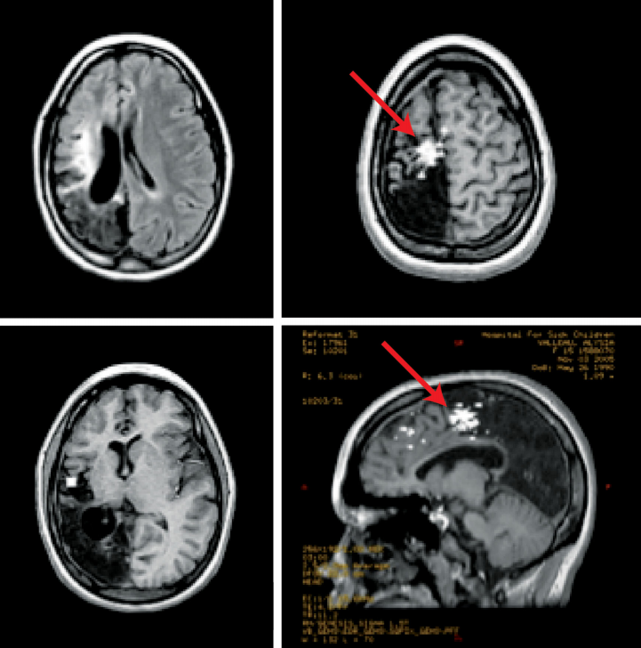 癲癇停藥后復(fù)發(fā)率高嗎