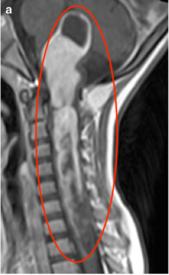 腦干膠質(zhì)瘤全切除圖片