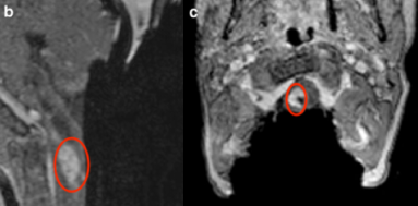 腦膠質(zhì)瘤——腦干膠質(zhì)瘤全切