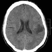 腦膠質(zhì)瘤早期癥狀有哪些？