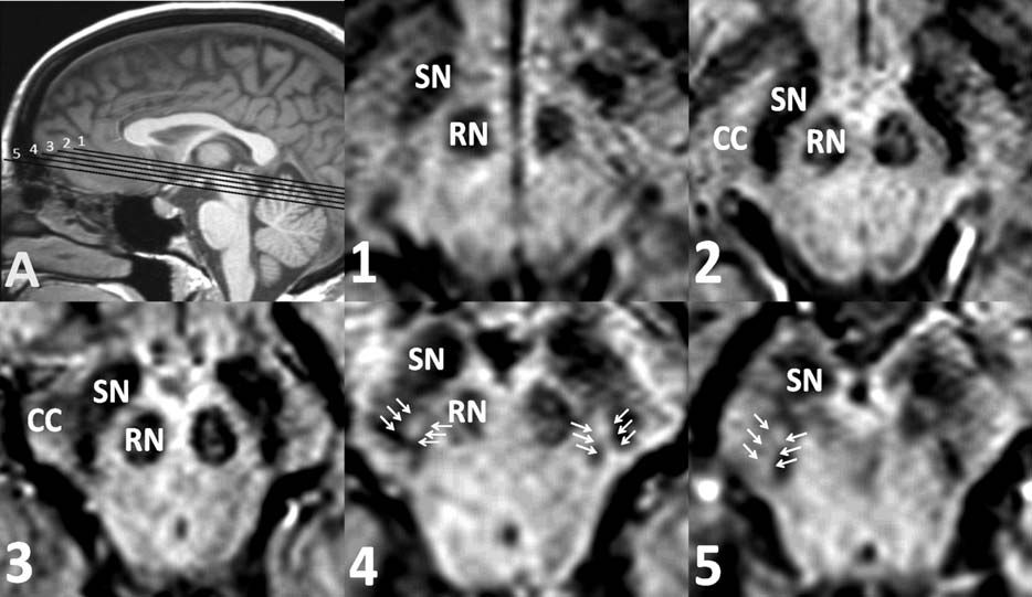 帕金森病和帕金森綜合征