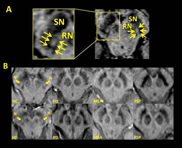 帕金森病和帕金森綜合征