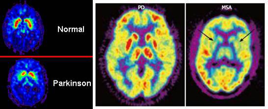 FDG-PET顯示PD基底節(jié)代謝活動得到保留，而MSA基底節(jié)代謝明顯減低