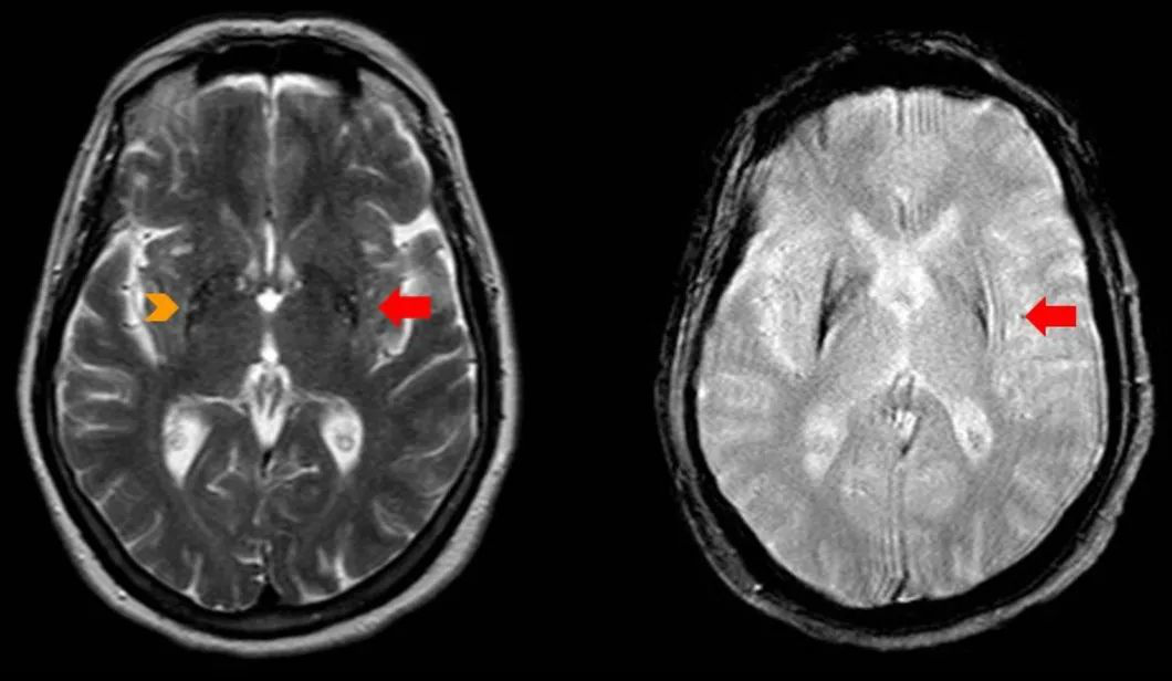 T2WI殼核后部線樣高信號，伴鐵沉積