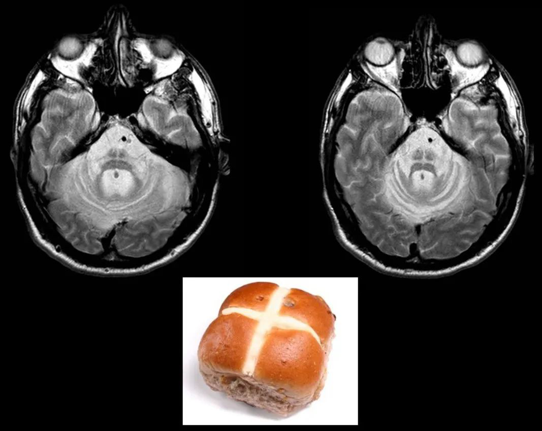 欖、橋腦、小腦中腳和小腦的萎縮