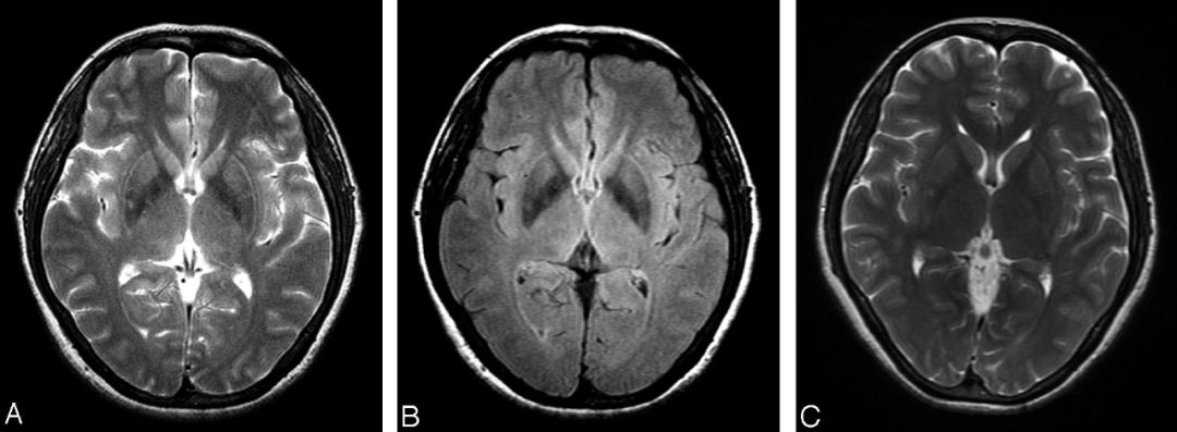 T2WI及FLAIR正常人殼核外側(cè)連續(xù)高信號