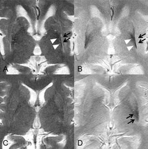 T2WI 及 T2* 殼核鐵沉積伴部分萎縮