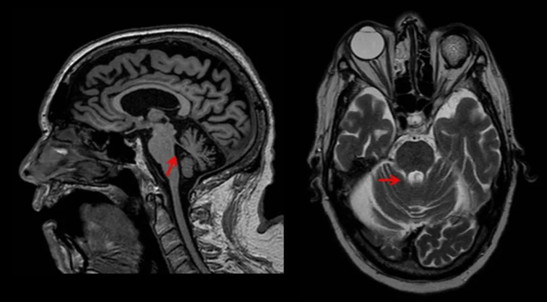 PSP中小腦上腳萎縮