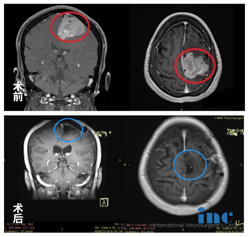腦膜瘤案例_腦瘤治療案例匯總