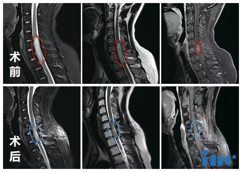 脊髓內(nèi)腫瘤案例——腦瘤治療案例