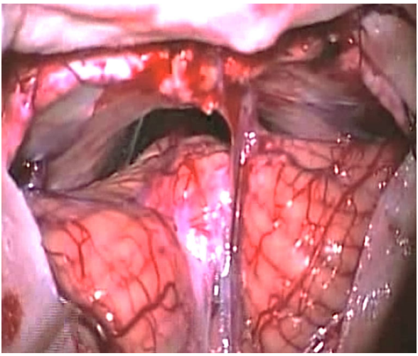 松果體腫瘤案例
