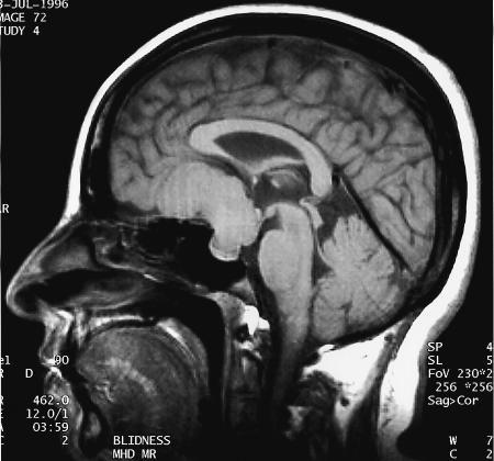 生完孩子三周后被診斷為腦膜瘤，妊娠期腦膜瘤治療策略的臨床研究