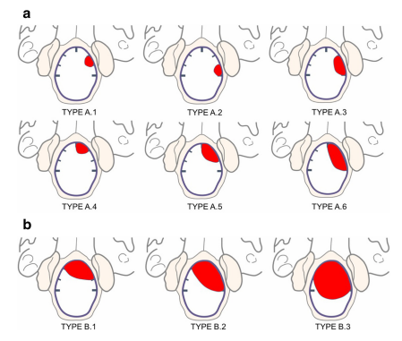 枕骨大孔區(qū)腦膜