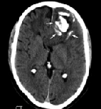 什么是腦部膠質(zhì)瘤？少枝膠質(zhì)瘤能治好嗎？