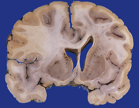 問(wèn)：少突膠質(zhì)瘤遺傳嗎？