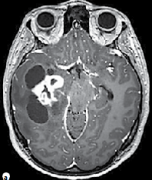 致癲癇性腫瘤怎么治療？腫瘤全切后癲癇還會(huì)復(fù)發(fā)嗎？