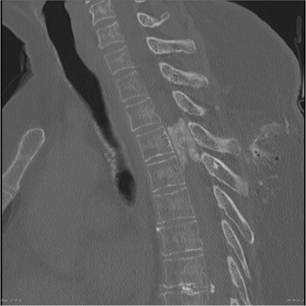 脊柱腦膜瘤鈣化嚴(yán)重嗎？