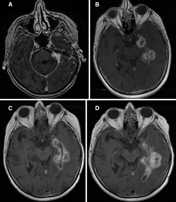 非典型腦膜瘤放療會(huì)帶來并發(fā)癥嗎？非典型腦膜瘤案例報(bào)告兩則剖析