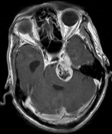 為什么長三叉神經(jīng)鞘瘤？