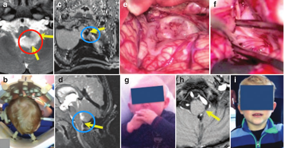 延髓膠質(zhì)瘤手術(shù)成功率：看INC國(guó)際教授為15個(gè)月大男孩成功全切手術(shù)
