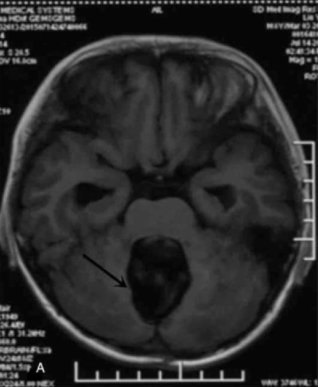 少突膠質(zhì)瘤三級(jí)生存期