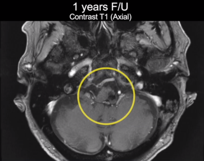 教授手術(shù)視頻：乙狀竇后髁上入路順利全切延髓海綿狀血管瘤，術(shù)后3年沒有復(fù)發(fā)