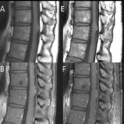 脊髓膠質(zhì)瘤手術(shù)多久可以完全康復(fù)？