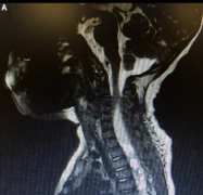 兒童原發(fā)性脊髓神經(jīng)膠質(zhì)瘤好治嗎？