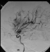 國(guó)際專家主治病例：早期手術(shù)的確利于小兒煙霧病的治療