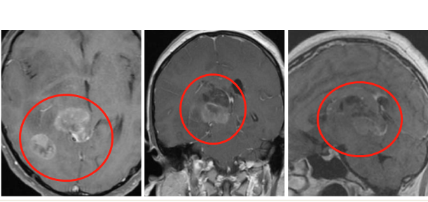 多發(fā)性膠質母細胞瘤案例