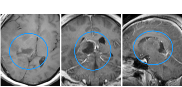 多發(fā)性膠質母細胞瘤術后