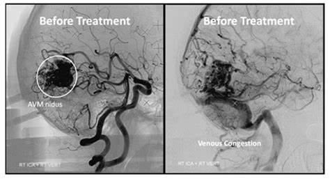 問：腦動靜脈畸形栓塞有用嗎？