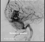 問：腦動(dòng)靜脈畸形栓塞有用嗎？
