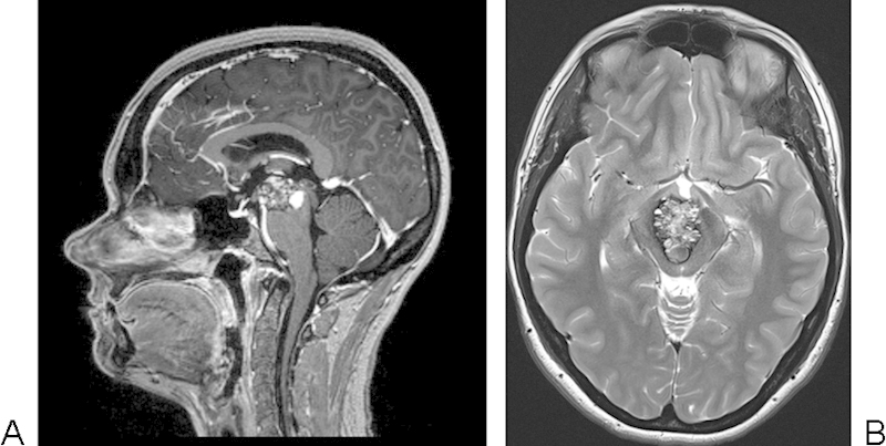 腦干海綿狀血管瘤