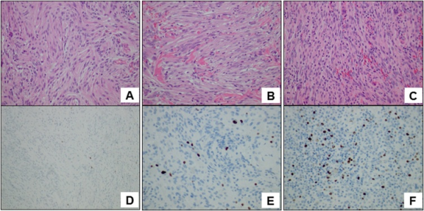 蝶骨嵴腦膜瘤嚴重嗎？