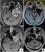 蝶骨嵴腦膜瘤嚴(yán)重嗎？?jī)?nèi)鏡下經(jīng)蝶竇入路切除蝶骨嵴腦膜瘤案例一則