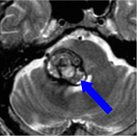 腦干海綿狀血管瘤的特征和癥狀