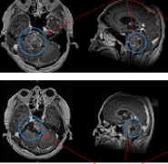 成人腦干膠質(zhì)瘤治好案例